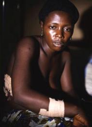 This woman was shot by the Sierra Leone police during the Bumbuna mining protests.