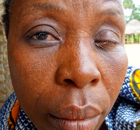 A Sierra Leonean lady already losing her eyesight. And there could be further not so visible complications. Who can help her and others?