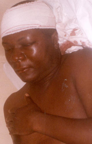 Tom Nyuma in Bo hospital after attack by Leatherboot and company - Photo: AWOKO
